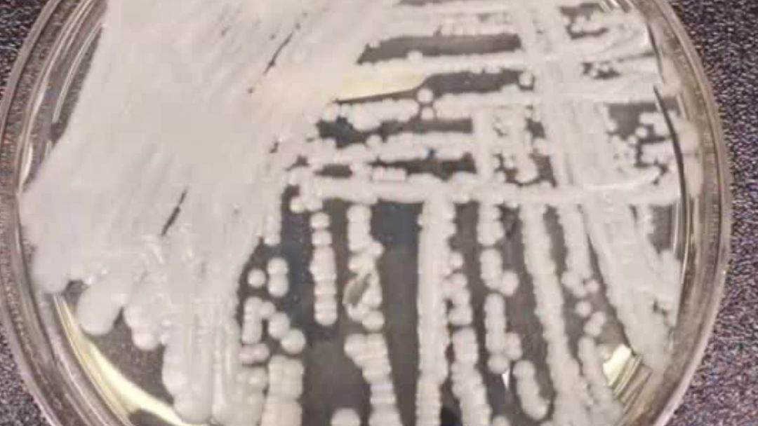 Un hongo mortal y resistente a medicamentos se propaga con rapidez en EEUU: hay 27 estados afectados | ViX