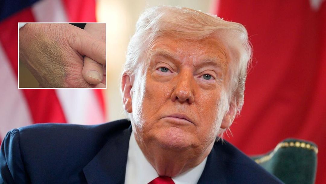 Trump dice que los moretones en sus manos son por un consumo elevado de aspirina: las noticias del día | ViX