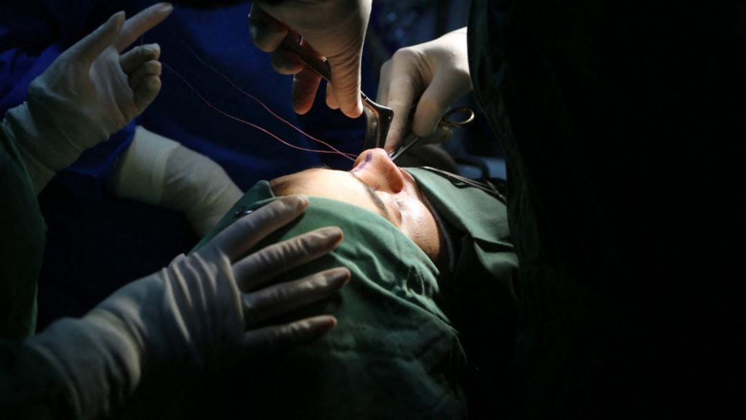 Rinoplastia: la cirugía más practicada por hombres y mujeres | ViX