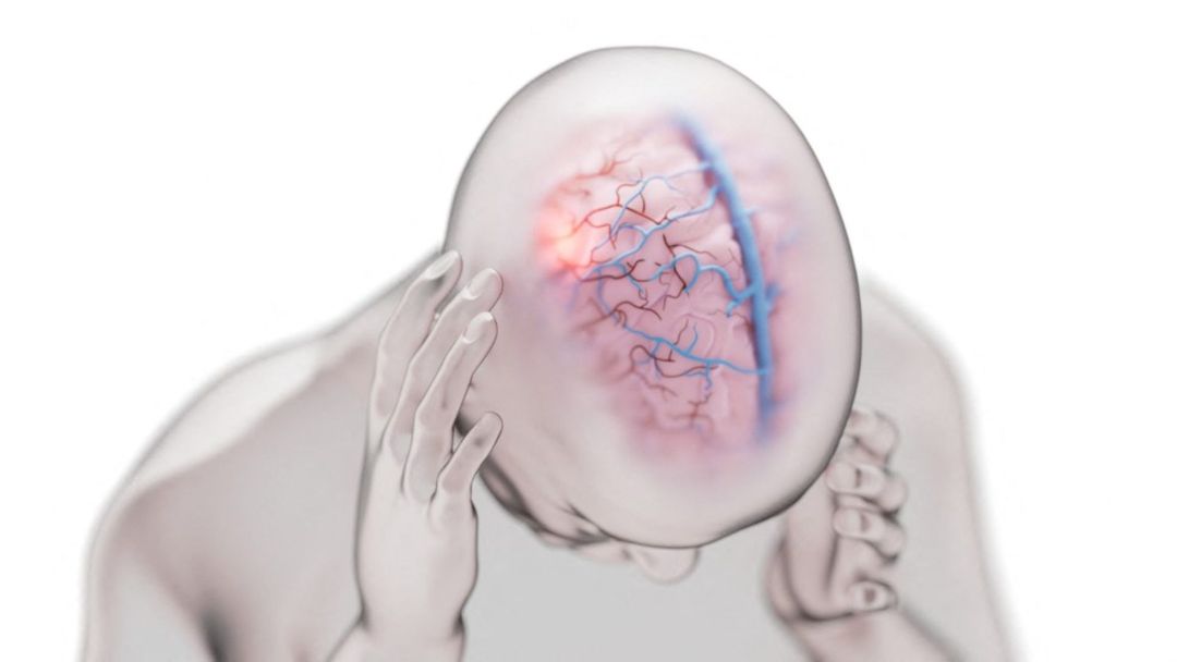 Intensos fríos pueden causar dolores de cabeza e incluso migraña | ViX