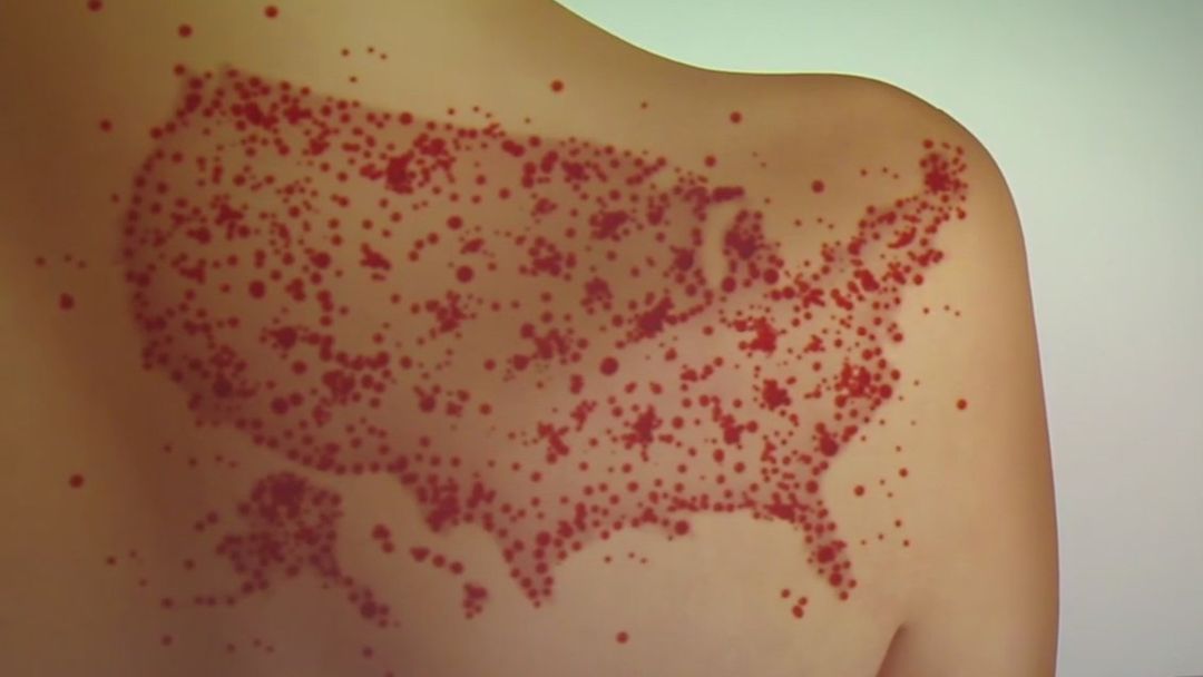 EEUU podría perder status ante la OMS de país libre de sarampión | ViX