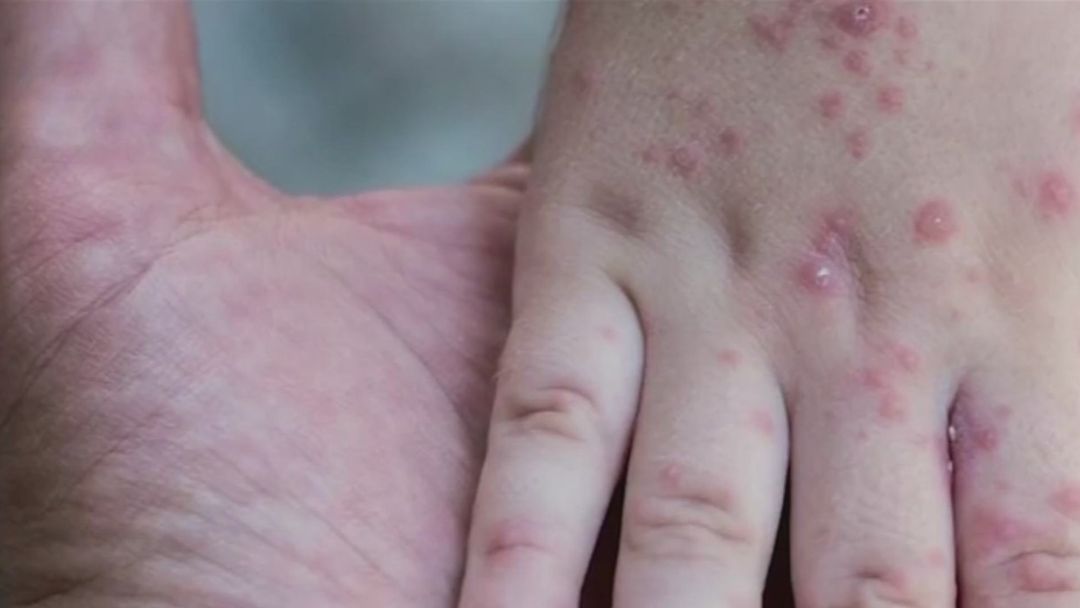 Inmigrante en centro de ICE en Texas denuncia falta de protocolos ante brote de sarampión | ViX