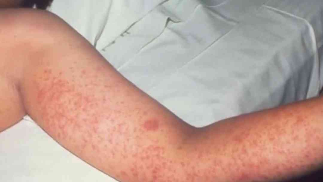 Rebrote de sarampión en EEUU: ¿Cuál es la población más vulnerable por esta enfermedad? | ViX