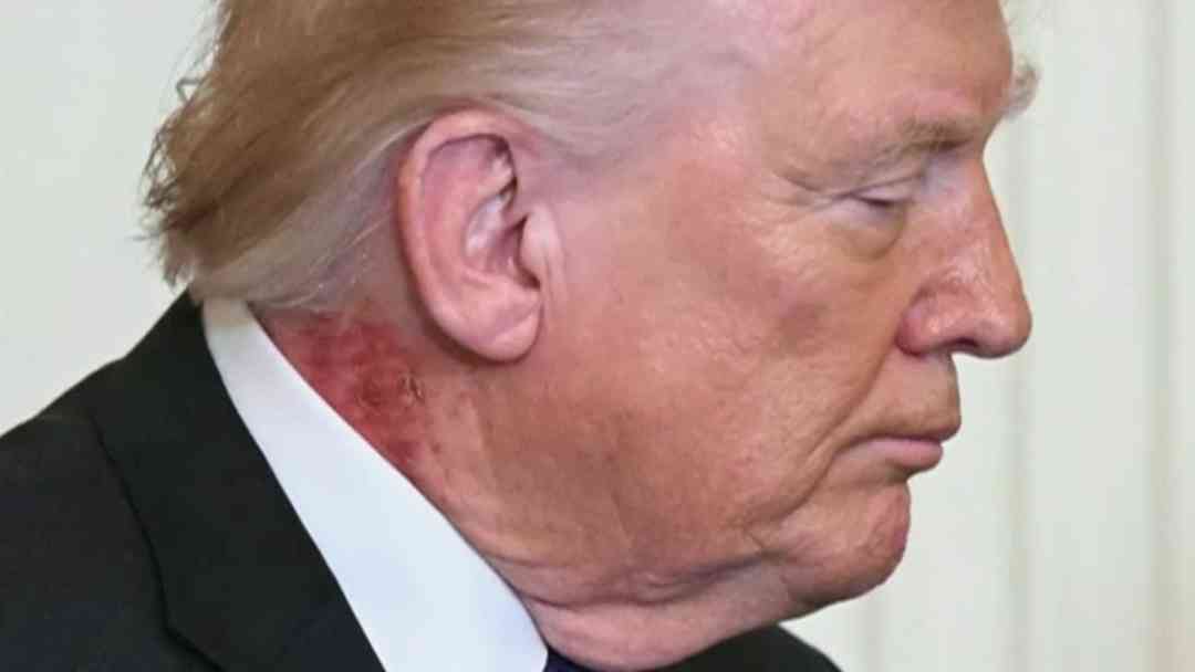 ¿Dermatitis o algo más? Experta analiza el área enrojecida en el cuello del presidente Trump | ViX