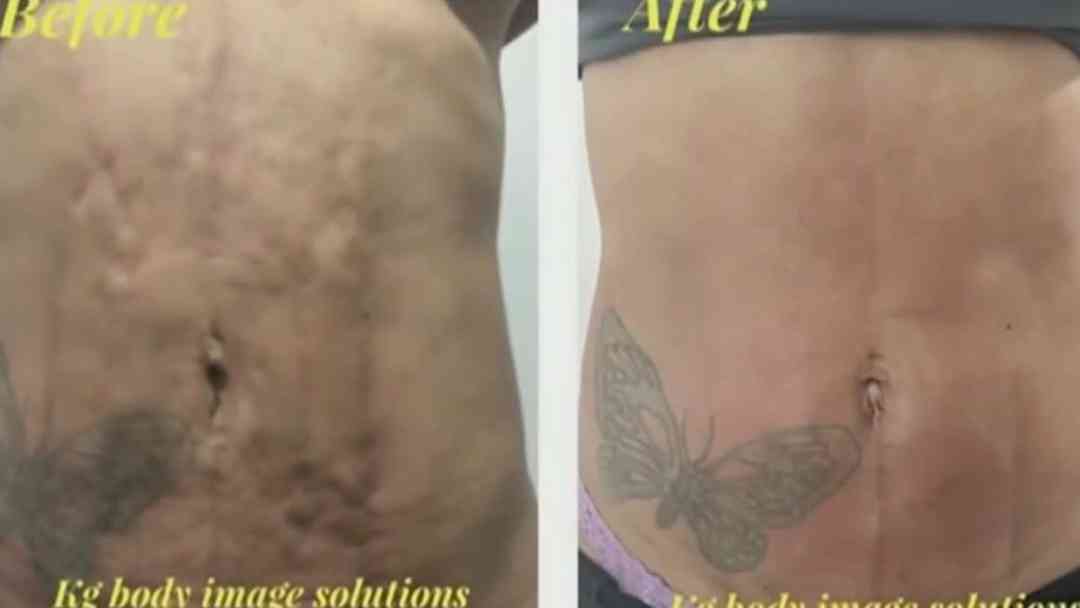 Evita complicaciones tras tu cirugía estética: Cómo detectar el exceso de tejido fibroso a tiempo | ViX