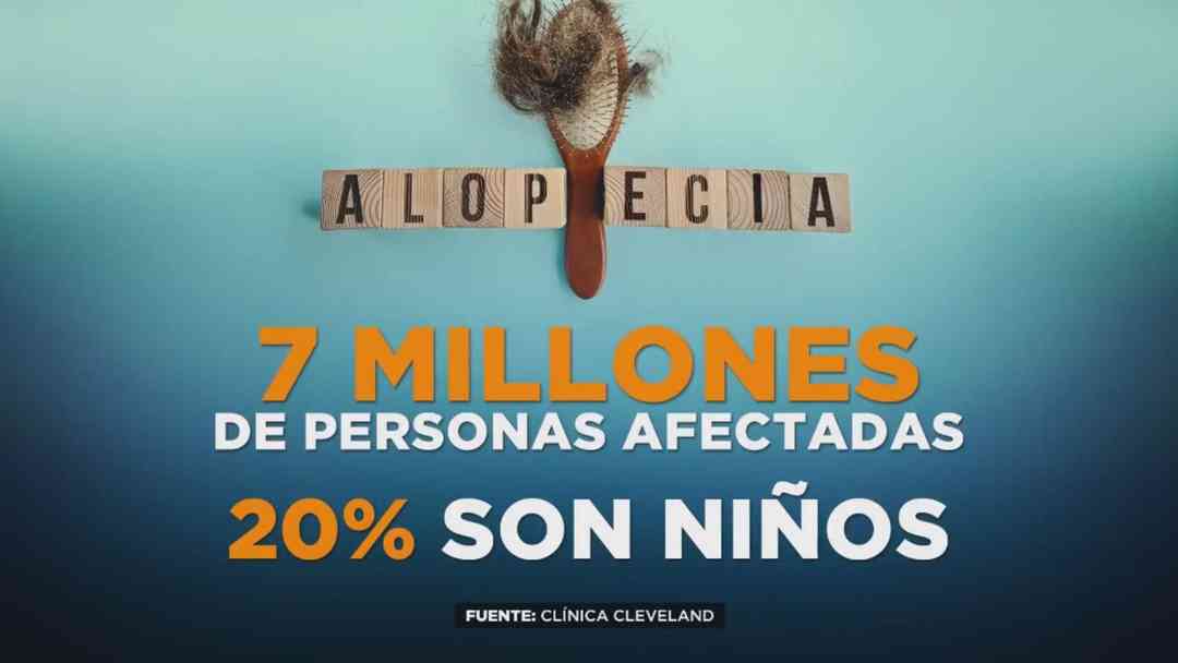 Alopecia en niños en aumento, cómo detectar síntomas y atenderlos | ViX