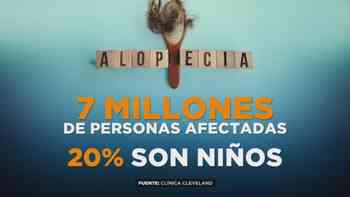 Alopecia en niños en aumento, cómo detectar síntomas y atenderlos