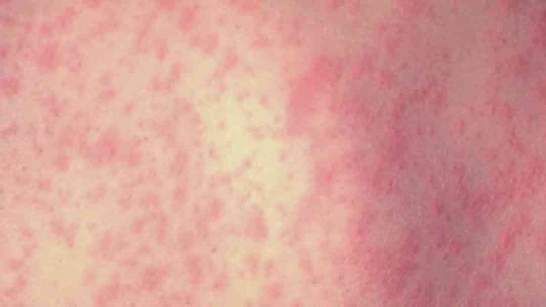 Sarampión en EEUU; pruebas genéticas alertan de propagación silenciosa del virus | ViX