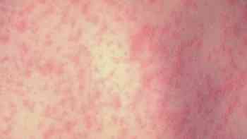 Sarampión en EEUU; pruebas genéticas alertan de propagación silenciosa del virus