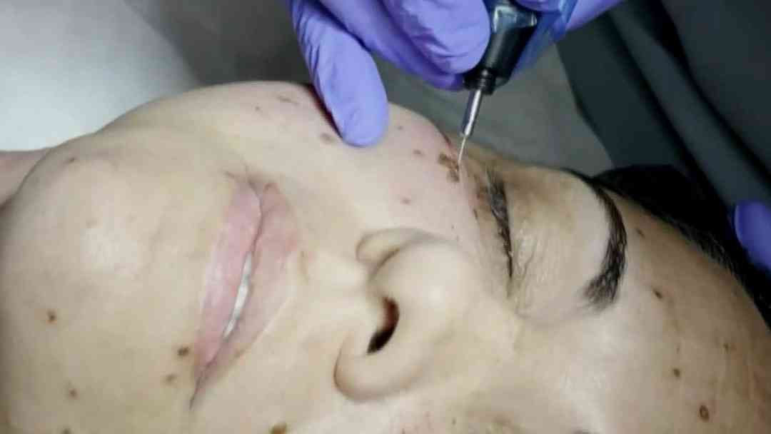 Lifting facial sin cirugía, ni bisturí ¿la tecnología actual como secreto de belleza? | ViX
