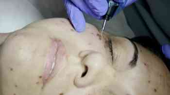Lifting facial sin cirugía, ni bisturí ¿la tecnología actual como secreto de belleza?