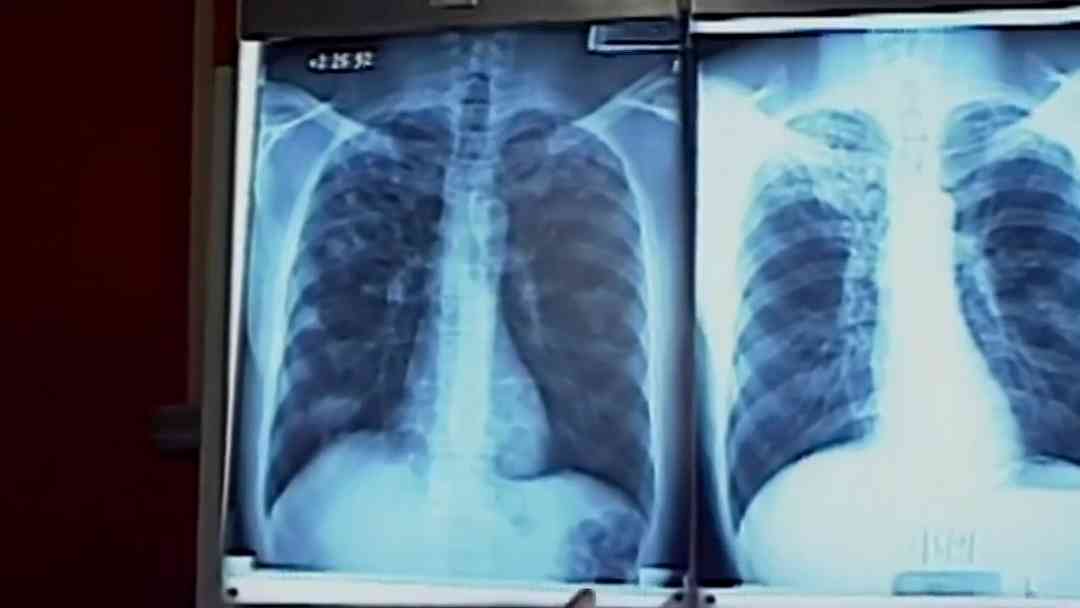 NY suma 22 hospitalizados por brote de legionelosis, ¿en qué consiste y cómo se contagia? Entrevista | ViX